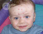 nino-con-varicela