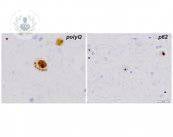huntington-histologia