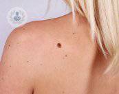 lunares-cancerosos