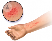 Conoce cómo identificar y tratar la dermatitis atópica o eczema