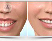 cirugia-mucogingival