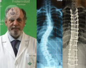 cirugia-de-columna-avances