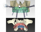 implantes-dentales-guiados-por-ordenador