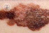 El cáncer de piel puede producir metástasis