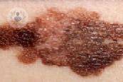 cancer-de-piel