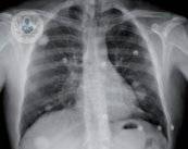 Los nódulos pulmonares pueden alertar del desarrollo de una enfermedad