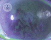 ojo-seco-fluoresceina