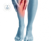 esclerosis-de-varices