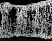 imagen-osteoporosis