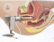 incontinencia-urinaria1