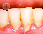 periodontitis-y-diabetes