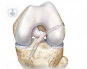 imagen-rotura-del-lca
