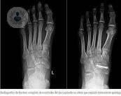 fractura-por-estres
