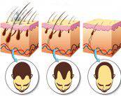 Tipos de alopecia y tratamientos