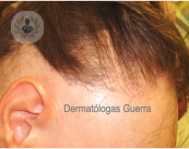 Cómo tratar la Alopecia Frontal Fibrosante