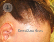 alopecia-frontal