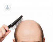 Injerto capilar: recuperación definitiva del cabello