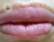 Queiloplastia, técnica para mejorar el aspecto de los labios