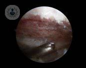 Artroscopia de hombro: riesgos y recuperación