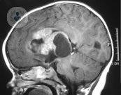 ¿Cómo se puede tratar un tumor cerebral?