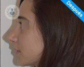 resultado-rinoplastia