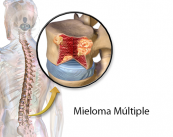 mieloma-multiple-cancer-de-la-sangre