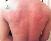 Dermatitis alérgica o reacción de la piel a determinadas sustancias 