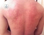 dermatitis-alergica-o-reaccion-cutanea