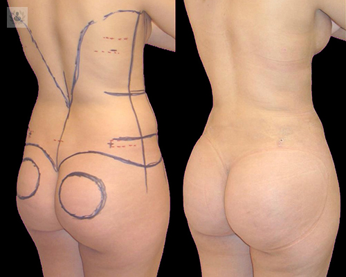 cirugia-de-contorno-corporal-tratamiento-contra-la-flacidez imagen de artículo