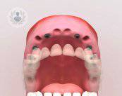 implantes-de-carga-inmediata-proceso