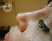 rinomodelacion-con-hidroxiapatita