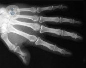 Tratamiento de la artritis psoriásica en las manos