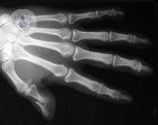 artritis-psoriasica