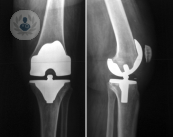 Cuándo es necesaria una prótesis de rodilla y garantías que ofrece al paciente