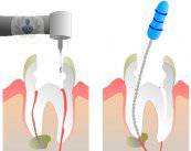 endodoncia-1