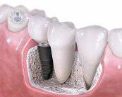 implantes-dentales-1