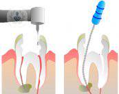 4 preguntas clave sobre la endodoncia