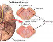 cerebro-con-parkinson