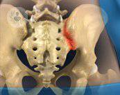 articulacion-sacroiliaca