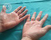 Tratamiento efectivo para hiperhidrosis de palmas de las manos y axilas