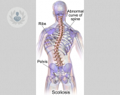 escoliosis