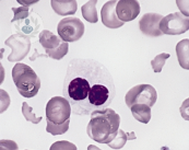 Síndrome Mielodisplásico, enfermedad sanguínea por falta de maduración de las células madre