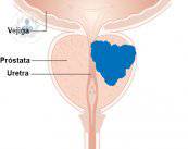 cancer-prostata-1