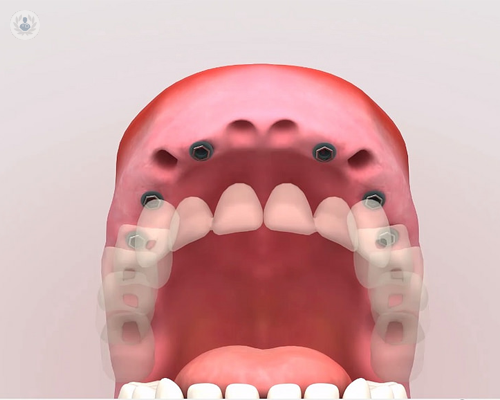 Conoce la técnica CSP (Cirugía Sin Puntos) para implantes dentales