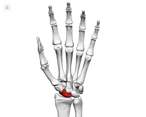 Cómo detectar la fractura en escafoides de la mano