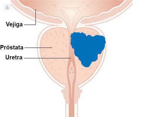 ¿Se puede prevenir el cáncer de próstata? 