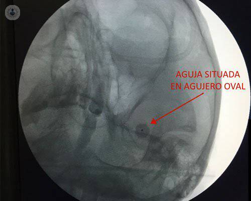 neuralgia-del-trigemino
