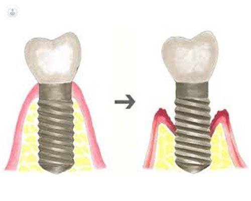 periimplantitis