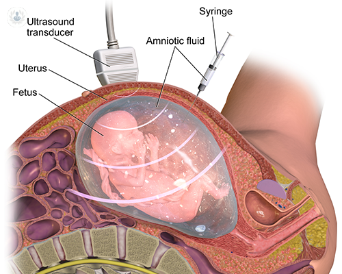 amniocentesis