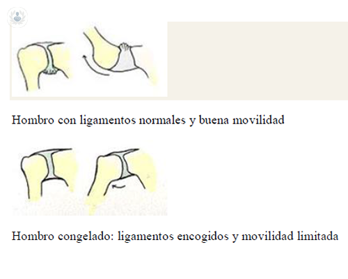 hombro-congelado-1